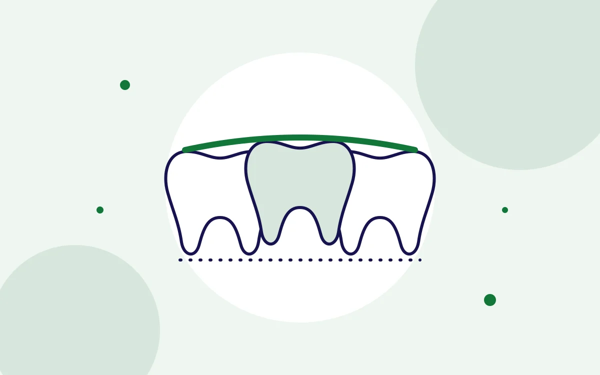 Illustration of a dental bridge replacing a missing tooth between two teeth for dental bridges