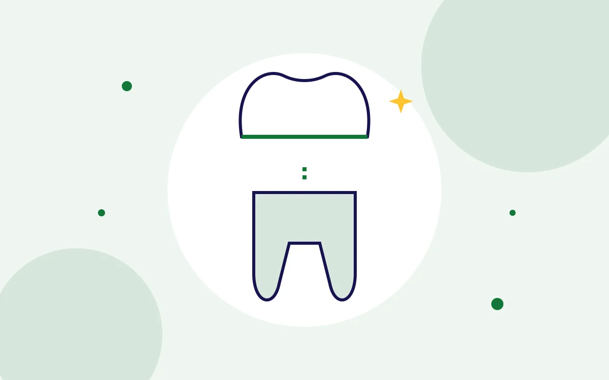 Illustration of a dental crown being placed over a prepared tooth for dental crowns