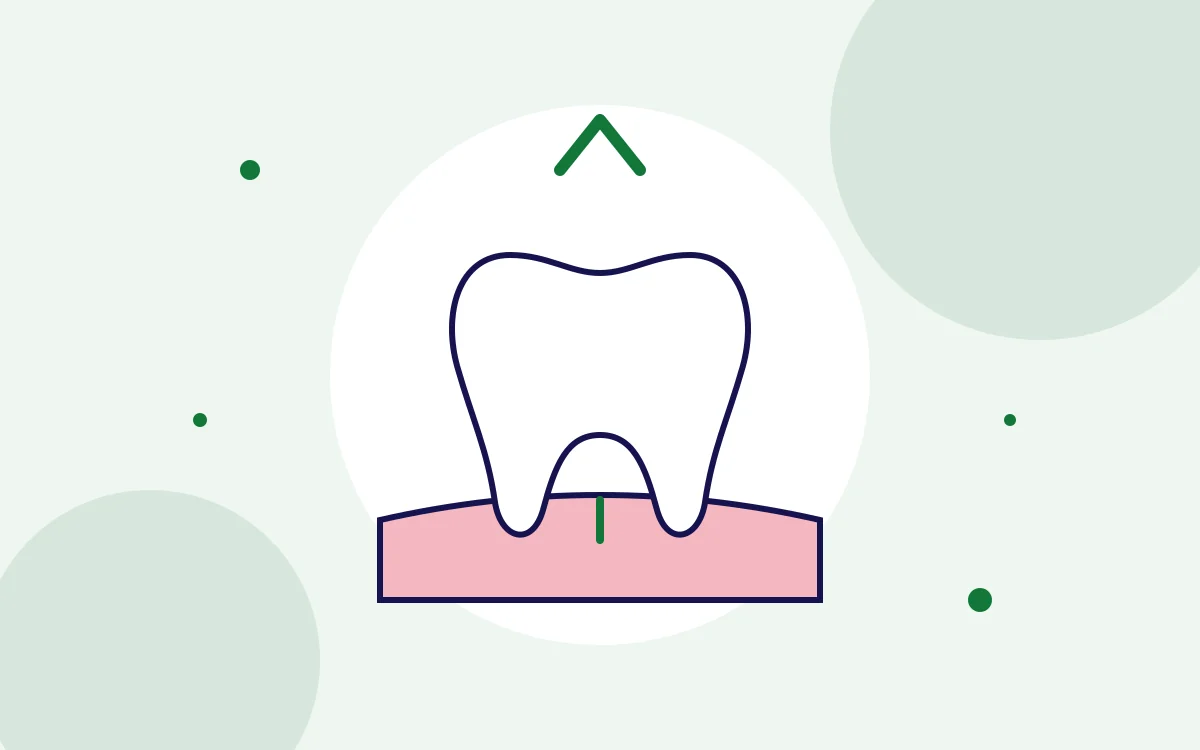 Illustration of a tooth being gently removed from the gum for wisdom teeth removal