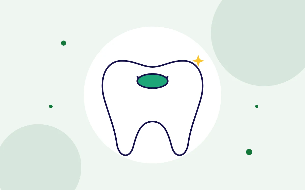 Illustration of a tooth with a tooth-coloured filling for tooth-coloured fillings