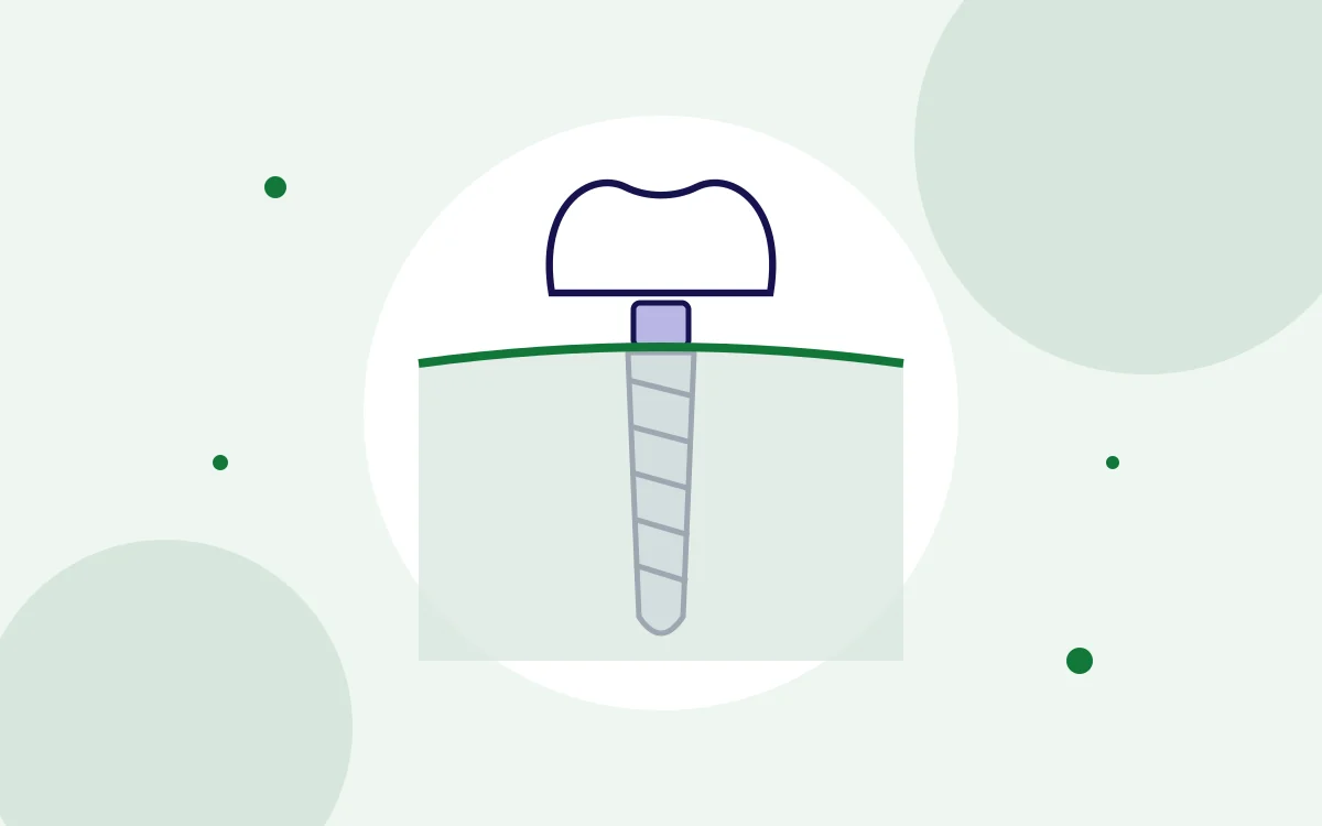 Illustration of a dental implant with a crown, post and abutment in the jaw for single tooth implants