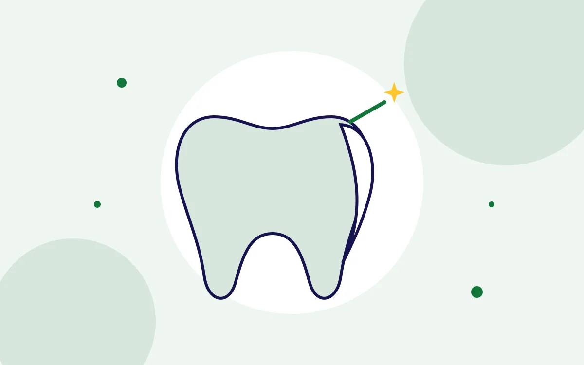 Illustration of a thin porcelain veneer fitted to the front of a tooth for porcelain veneers